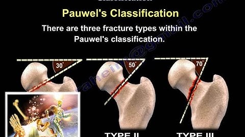 Femoral Neck Fracture Classification - Everything You Need To Know - Dr. Nabil Ebraheim