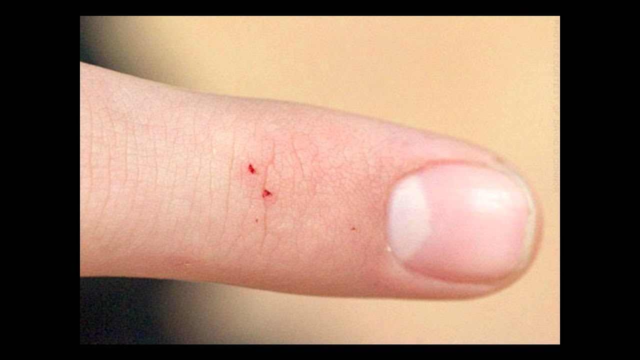 the evidence the charlie bite youtube pin size red dots on skin