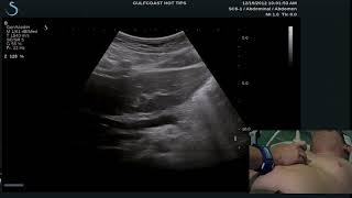 Hot Tips - Locating the Common Bile Duct with Ultrasound