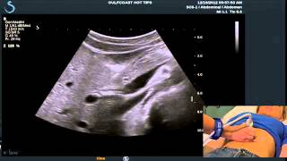 Hot Tips - Locating the Common Bile Duct with Ultrasound