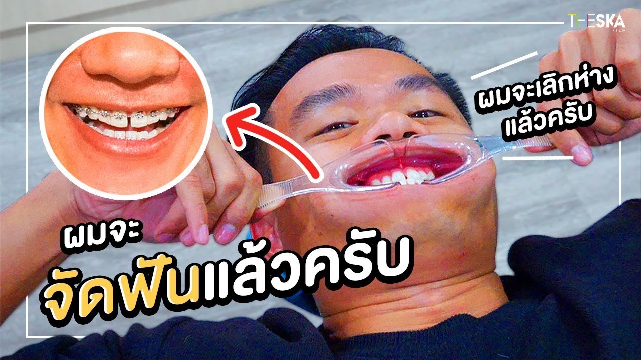 จัดฟันเดอะซีรีย์ Ep.1 ผ่าตัดขากรรไกร การเปลี่ยนแปลงครั้งใหญ่ !!!
