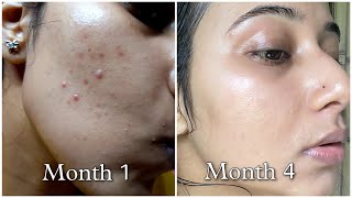 My Tretinoin Journey Part-3 | Less Pimples & Dryness | Difference b/w Retino-A & Retino-A Micro