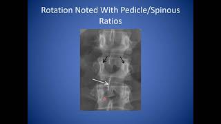 How to Read a Lumbar Spine Xray | Reading Standing Spine Xray