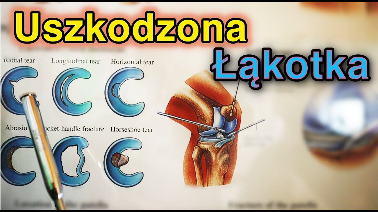 Łąkotka. Uszkodzenie łąkotki. Tejpowanie łąkotki. Meniscus taping