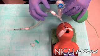 NICU Procedures- Surfactant administration in a preterm infant screenshot 3