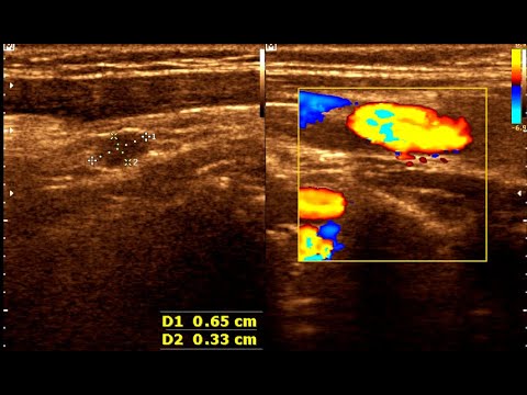 Neck Mass | Cervical Lymph node | Cervical Lymphadenopathy | Neck Ultrasonography