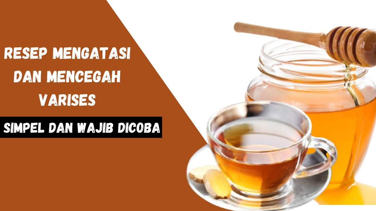 SIMPEL DAN WAJIB DICOBA!Resep Mengatasi Dan Mencegah Varises Secara