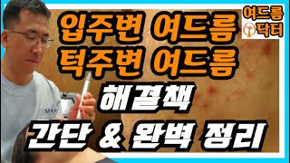 입주변 여드름, 턱주변 여드름 해결책!!! (간단 & 확실한 정리)