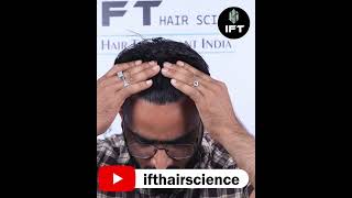 “Revolutionizing Hair Loss Treatment: A Success Story of Hair Transplant by IFT Hair Science”