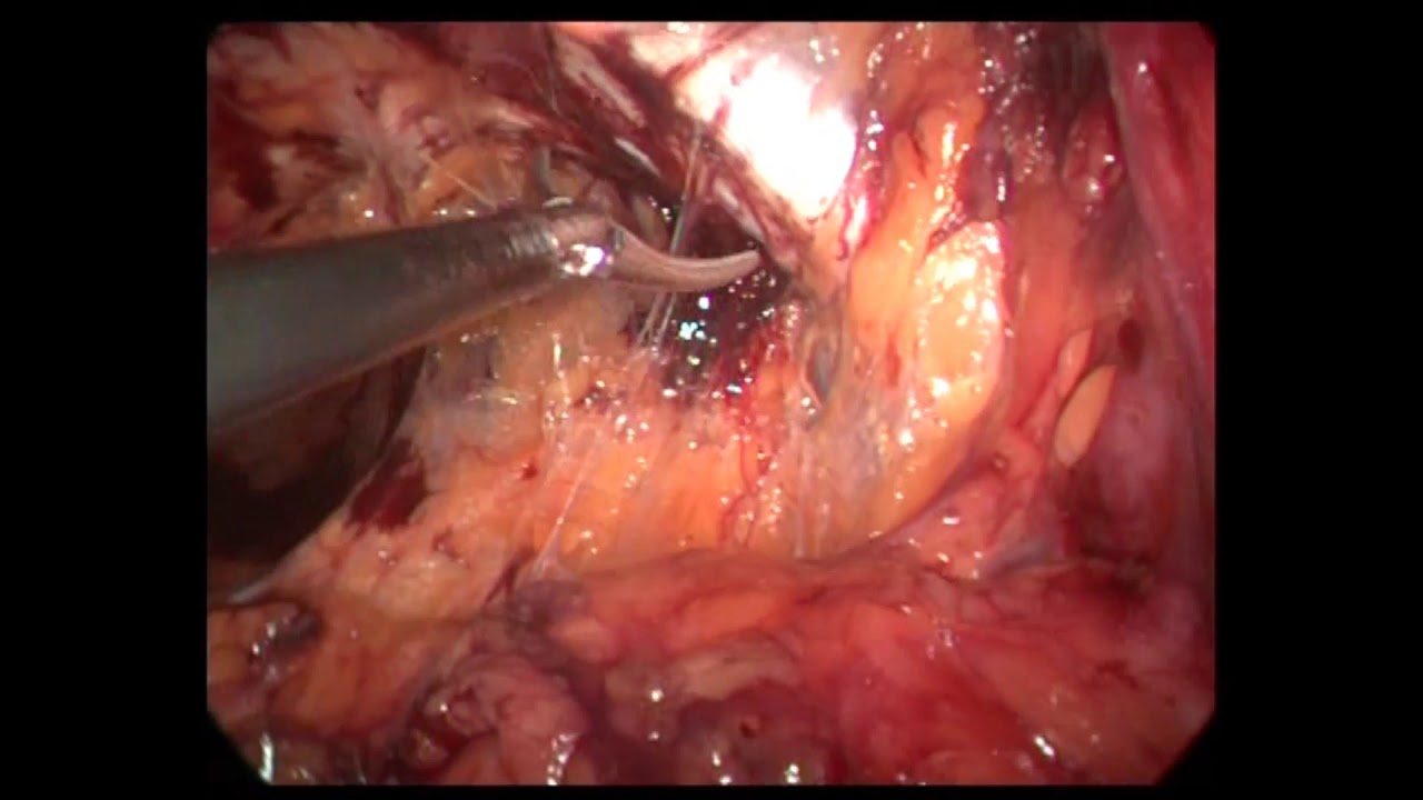 е-ТЕР. Трансваскулярная паховая грыжа справа - YouTube