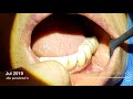 Management of periimplant mucosal problems vestibuloplasty and free gingival graft dr alex hong