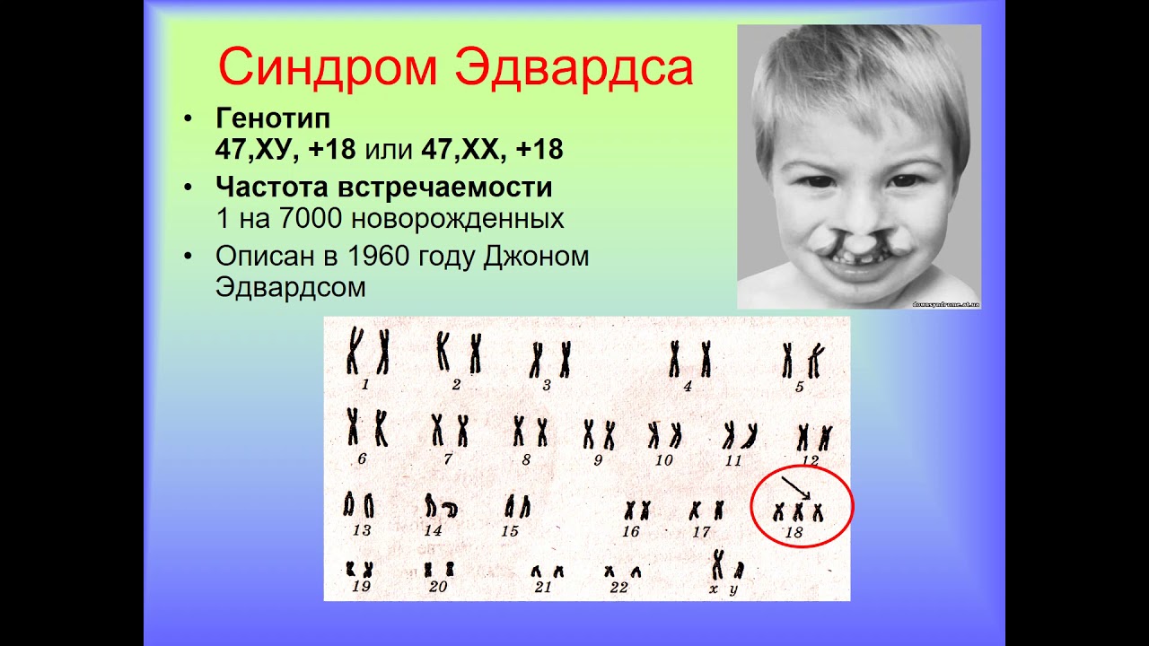 Пересадка хромосом. Эдвардс синдром кариотип. Кариотип больного с синдромом Эдвардса. Синдром Эдвардса хромосомная формула. Синдром Патау (трисомия по 13-й хромосоме).