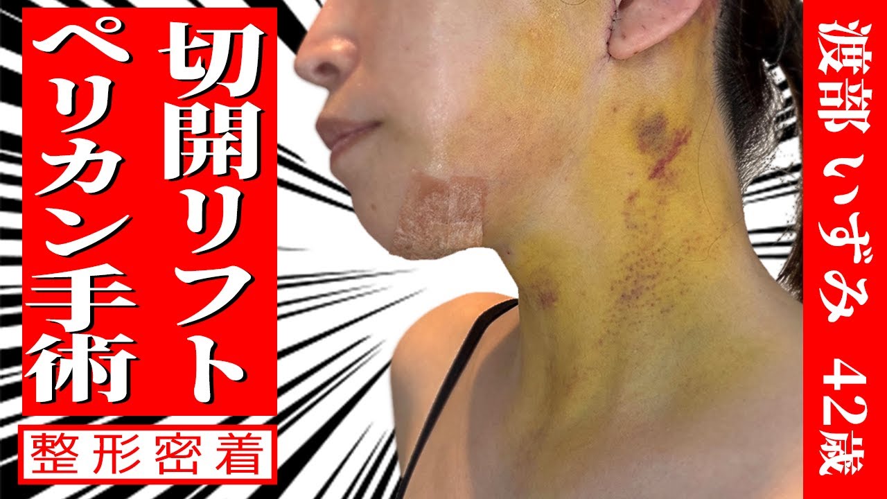 切開リフト+ペリカン手術～整形密着3カ月～