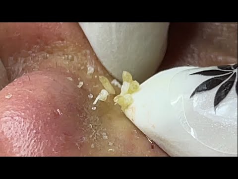 Video Ca Mụn mũi tại spa Linh My Đặng Phan Thiết - youtube