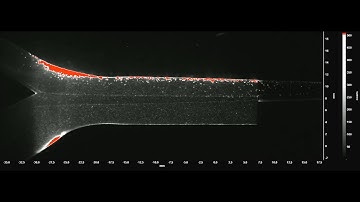 PIV Analysis of Catheter Injection through a Carotid Bifurcation Model