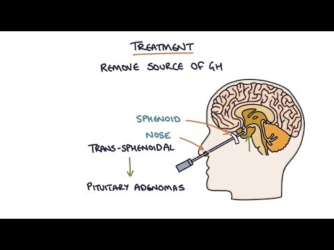 Video: Acromegaly - Symptoms, Causes, Diagnosis, Treatment Methods