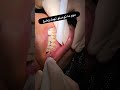 التهاب اللثة وتراكم الكلس مهم ما تصلوا لهاي المرحلة