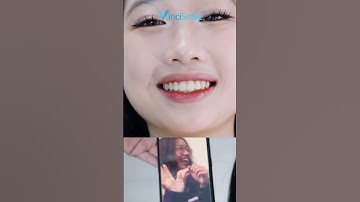 Bạn đã sẵn sàng thay đổi diện mạo với Niềng răng trong suốt VinciSmile?