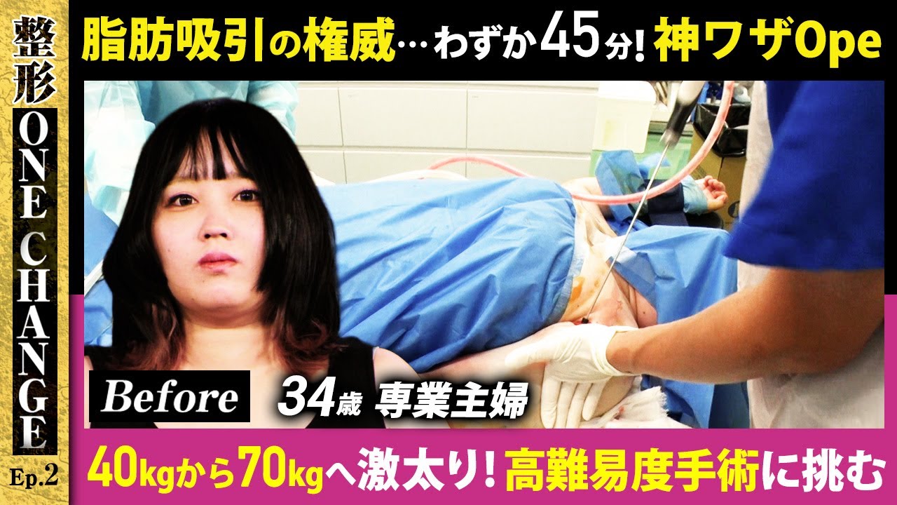脂肪吸引の権威⋯わずか45分！神業オペ 34歳専業主婦 40kgから70kgへ激