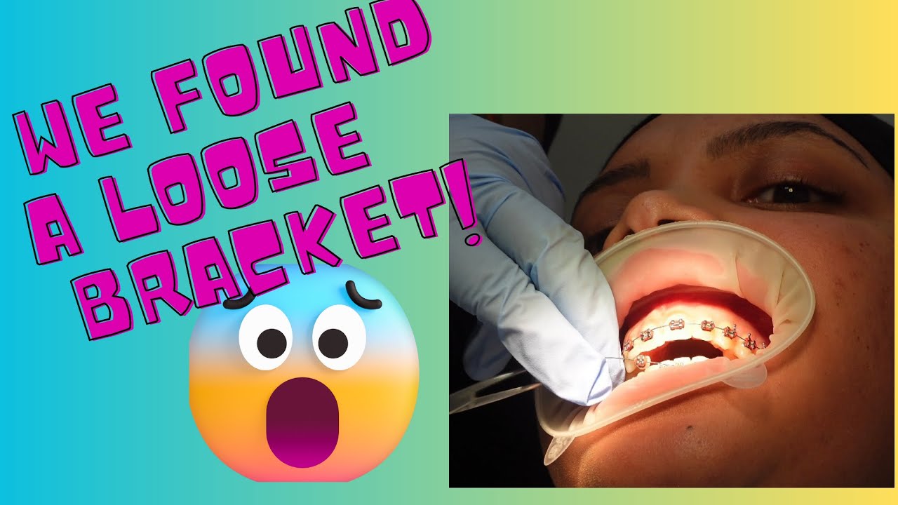 😳 BRACKET GOT LOOSE 🦷 + New braces colours ♥️ 💚 South African