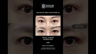 선천성 갈고리눈 축돌리기 무보정 사례모음. zip #시선성형외과 #shrots