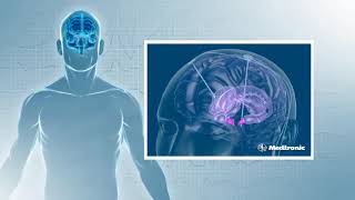 DBS    Deep Brain Stimulation   How does it work?
