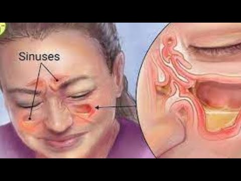 What is sinusitis Symptoms and how to relieve it with home remedies