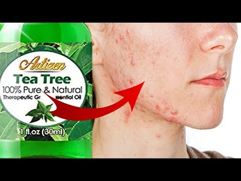 How To Cure Fungal Acne Naturally | FAST CHEAP CURE | MALASEZZIA FOLLICULITIS