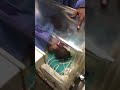 فريق طبي سوداني بقيادة العقيد شرطة طبيب عصام السنجك اجراء عملية فصل توأم سيامي بنتين بمستشفى الشرطة