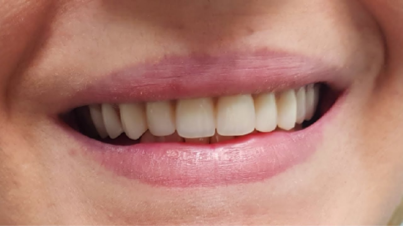 Qual A Melhor Cola Para Protese Dentaria
