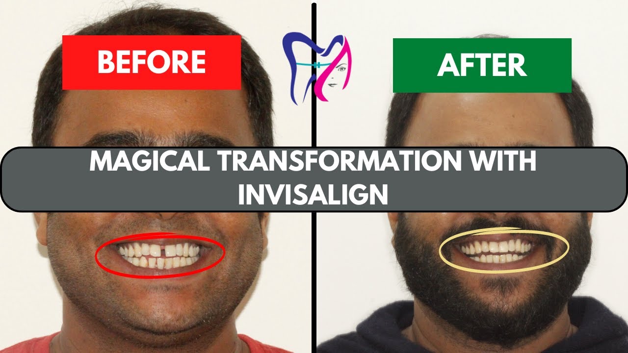Invisalign For Teeth Gap | Invisalign Before And After | Best Invisalign Provider In Bangalore