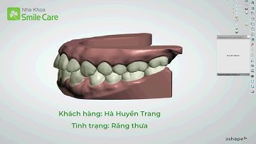 VIDEO 3SHAPE KHÁCH HÀNG HUYỀN TRANG - NIỀNG TRONG SUỐT SMILESALIGN