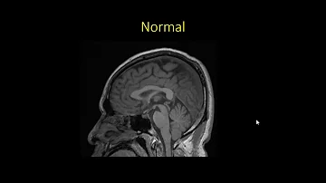 Como tratar cisto na glândula pineal?