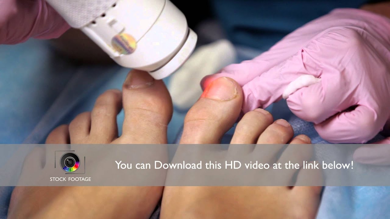 Podiatrist treating onychomycosis with a laser YouTube
