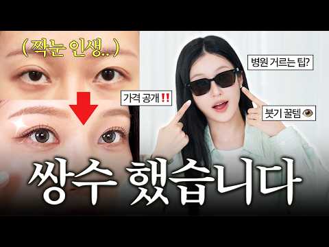 <strong>쌍수</strong> 했습니다🔥성형 한달차 솔직 후기 Q&amp;A (병원 꿀팁? 가격? 매몰vs절개? 회복 과정, 짝눈 눈매교정)