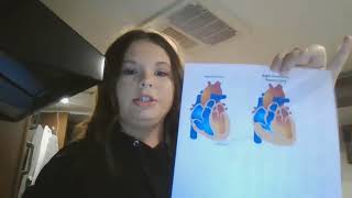 Teaching  2 Right Venticle Hypertrophy