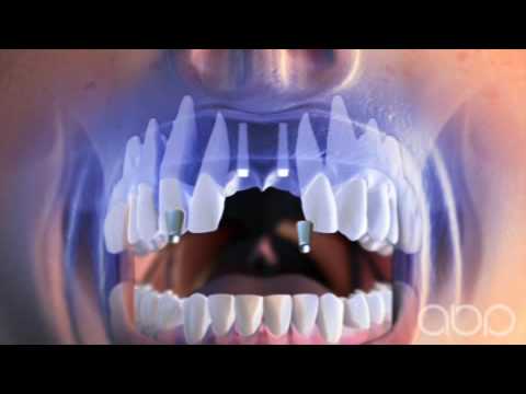 Dental Implant - 3D Medical Animation || ABP © - YouTube