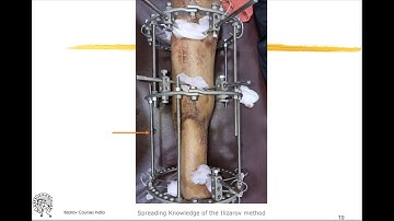Ilizarov Components & Instruments - Dr Pankaj Singh