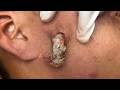 You Can Feel This Extraction Through The Screen | Massive Cyst Pimple Extraction
