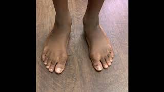 Extreme Pediatric Flat Feet