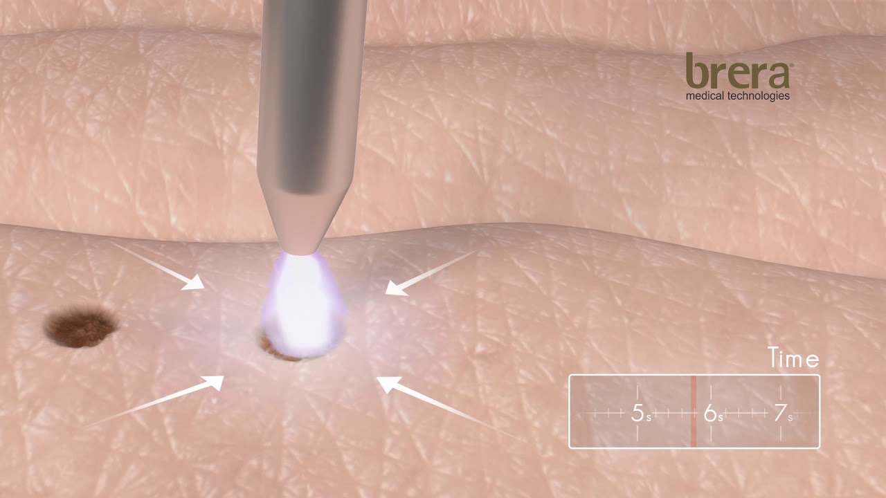 BRERAMEDICAL plasmage 3D