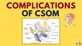 Complications Of Chronic Suppurative Ois Media Csom Part 1
