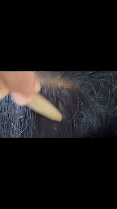 #fypviralシ #kutu #statisfying #satisfying #fyppppppppppppppppppppppp #kuturambut #india #xyzbcafypシ