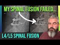 L4l5 spinal fusion failure 2 weeks after surgerynow what