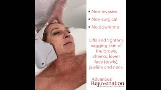 High Intensity Focused Ultrasound - Before After Results - By Advanced Rejuvenation