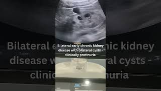 Proteinuria with Normal Kidney Size — Harmless or Chronic Disease ? early CKD on Ultrasound