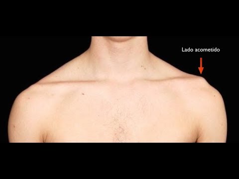 Bandagem Rígida para Luxação Acromioclavicular do Ombro - Clínica de Fisioterapia Dr. Robson Sitta