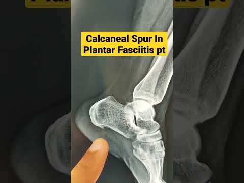 Video: Hjälper massage calcaneal sporre?