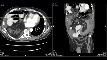 Morgagni hernia with closed loop small bowel obstruction
