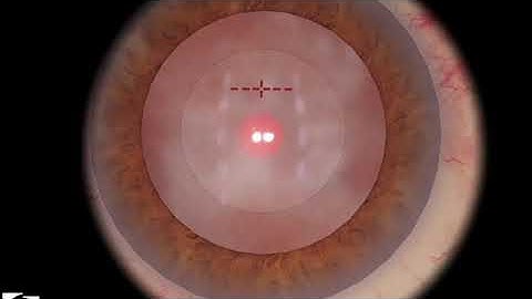 EyeSi CAT C Phaco Chopping Training, Level 6 (full nucleus, vertical chopper)